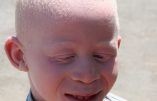 La police du Malawi autorisée à abattre les tueurs d’albinos