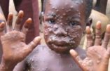 Royaume-Uni – Deux personnes venant du Nigéria porteuses de la « variole du singe »